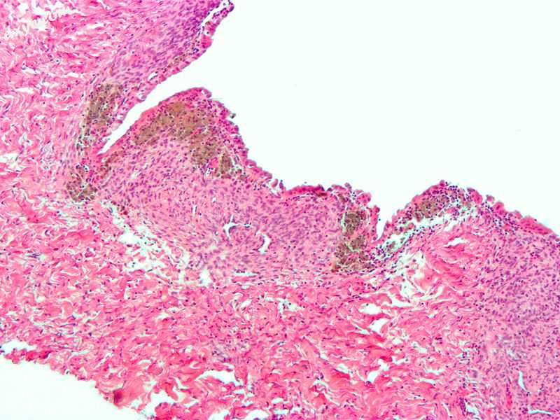 Micrograph of the wall of an endometrioma. All features of endometriosis are pre.jpg