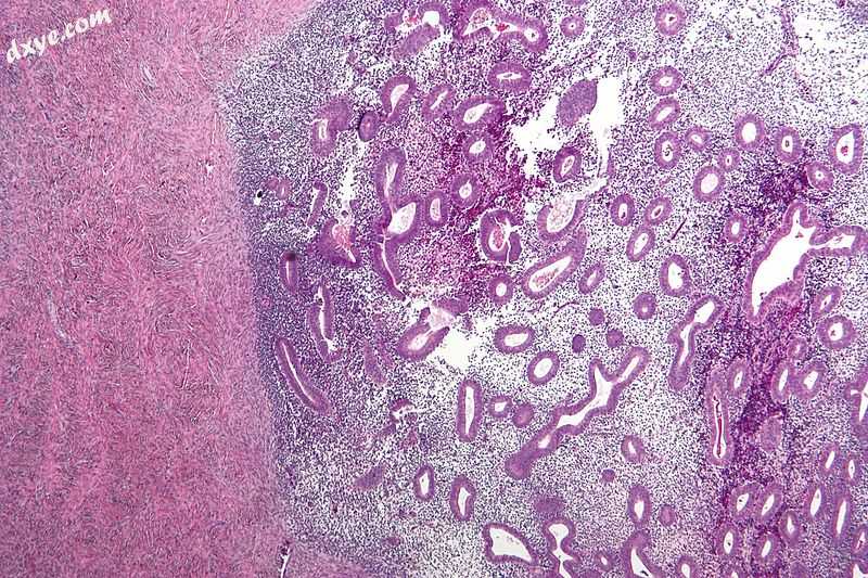 Micrograph showing endometriosis (right) and ovarian stroma (left). H&amp;E stain..jpg