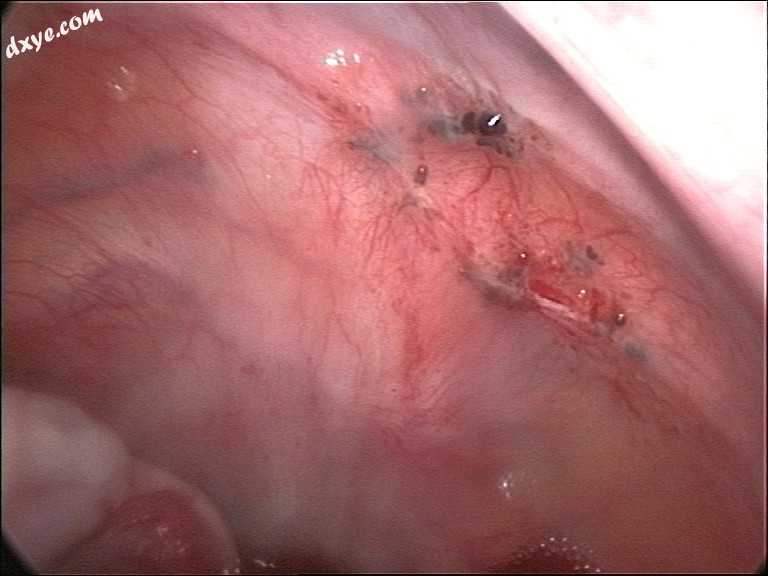 Laparoscopic image of endometriotic lesions at the 腹膜 of the pelvic wall.jpg