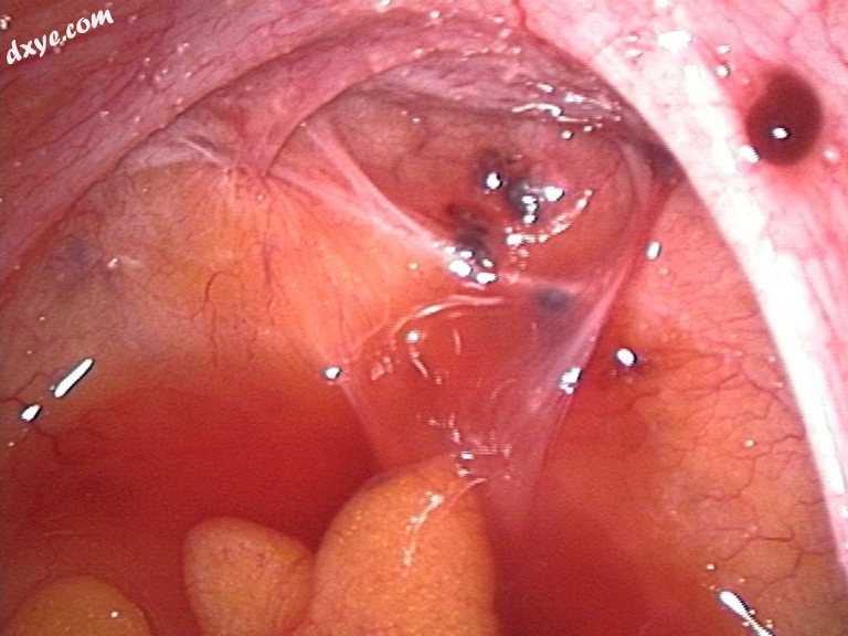 Laparoscopic image of endometriotic lesions in the Pouch of Douglas and on the r.jpg