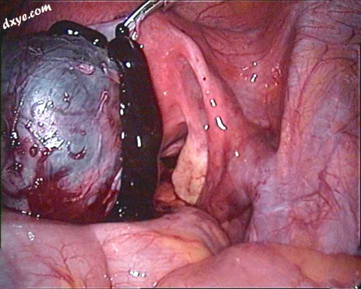 Endoscopic image of a ruptured chocolate cyst in left 卵巢..jpg