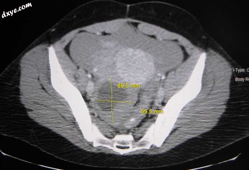 An Axial CT demonstrating a large hemorrhagic ovarian cyst. The cyst is delineat.jpg