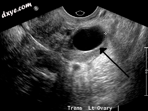 A 2 cm left ovarian cyst as seen on ultrasound.png