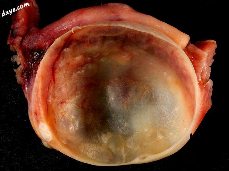 A simple ovarian cyst of most likely follicular origin.jpg