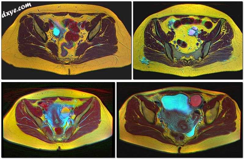 Four kinds of ovarian 囊肿 on MRI.jpg