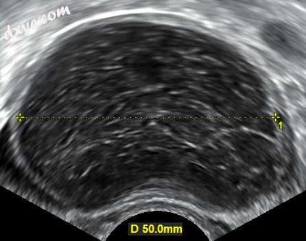 Transvaginal ultrasonography of a hemorrhagic ovarian cyst, probably originating.jpg