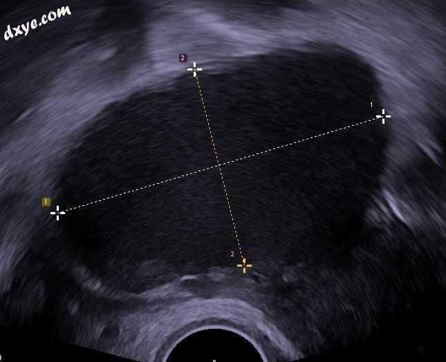 Transvaginal ultrasonography showing a 67 x 40 mm endometrioma, with a somewhat .jpg