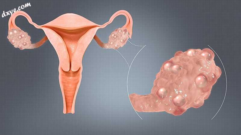Image of multiple ovarian 囊肿..jpg