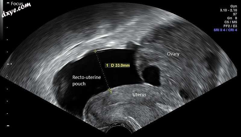 Vaginal ultrasonography in mild ovarian hyperstimulation syndrome - sagittal.jpg