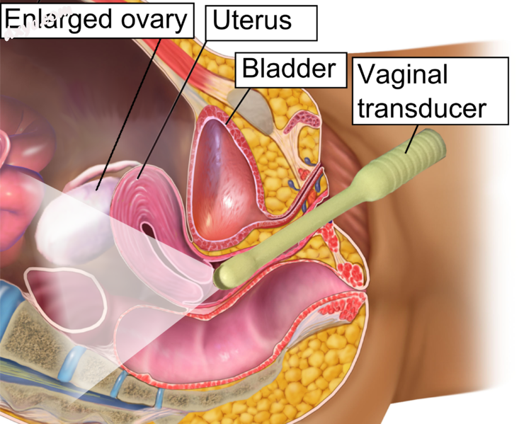 Vaginal ultrasonography in OHSS - sagittal.png