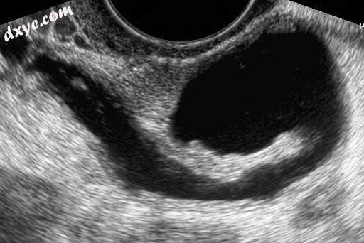 Left 输卵管积水 on gynecologic ultrasonography.jpg