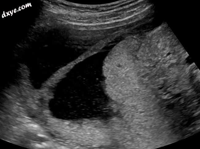 amniotic sheet on ultrasound.jpg