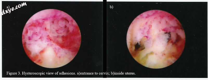 Hysteroscopic view..jpg