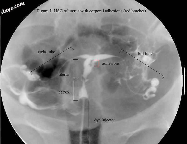 HSG view. Note not the same uterus as in ultrasound or hyst.jpg