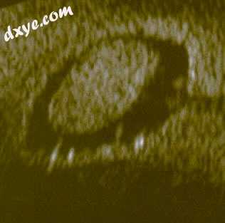 Endometrial polyp, viewed by sonography.jpg