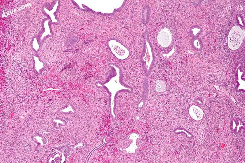 Micrograph of an endometrial polyp. H&amp;E stain..jpg