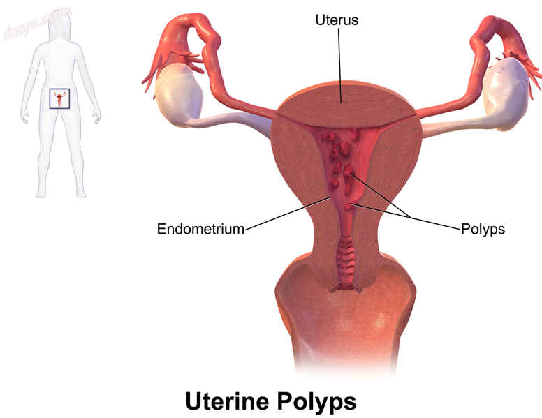 Uterine polyps.png