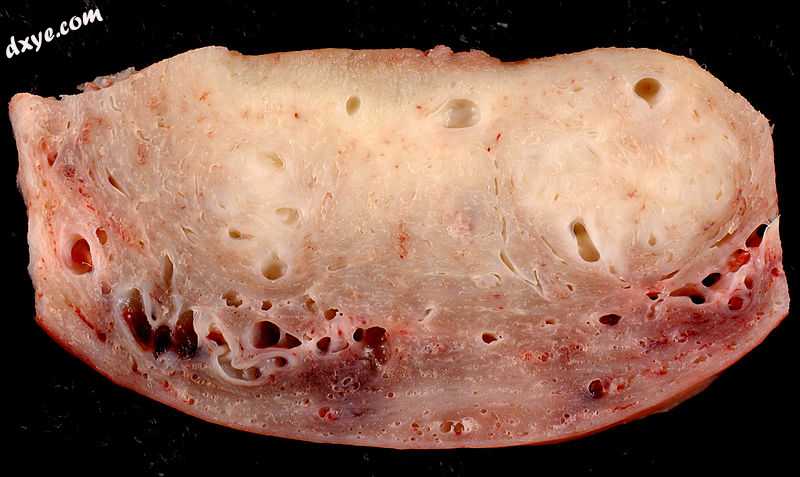 Cross section through the wall of a hysterectomy specimen of a 30-year-old woman.jpg