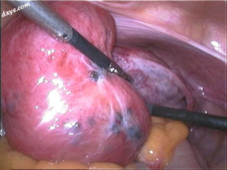 Adenomyosis uteri seen during laparoscopy soft and enlarged uteru.jpg