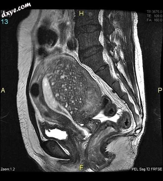 Sagittal MRI of a woman&#039;s pelvis showing a uterus with adenomyosis in the p.jpg