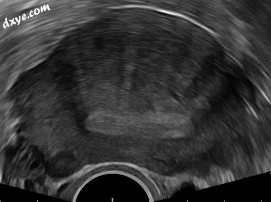 Transvaginal ultrasound of 子宫, showing the endometrium as a hyperechoic .jpg