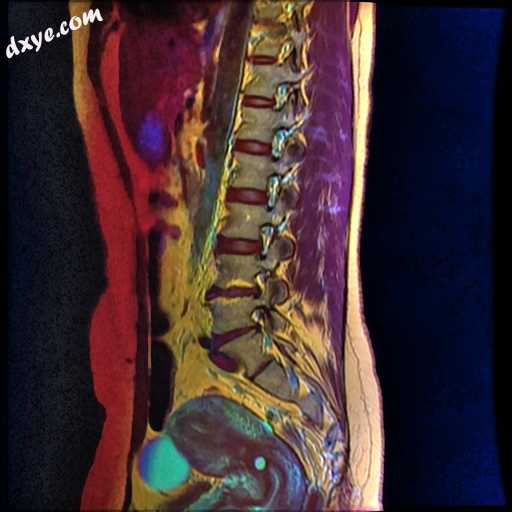 Color MRI showing 纳博特囊肿 as small blue circle in cervical region..jpg