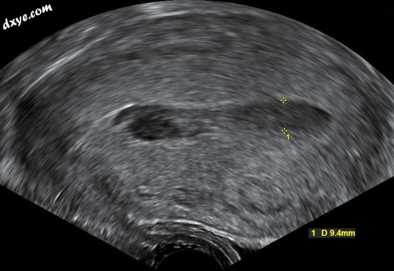 Transvaginal ultrasonography of a hematometra after childbirth, seen as a hypoec.jpg