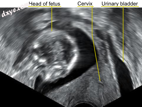 A transvaginal ultrasound showing a 子宫后倾 during p.png