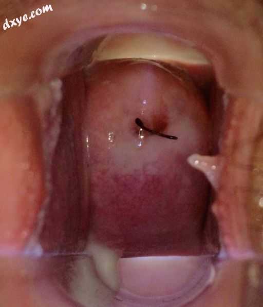 Normal vagina and cervix during a medical speculum exam demonstrating IUD string.jpg