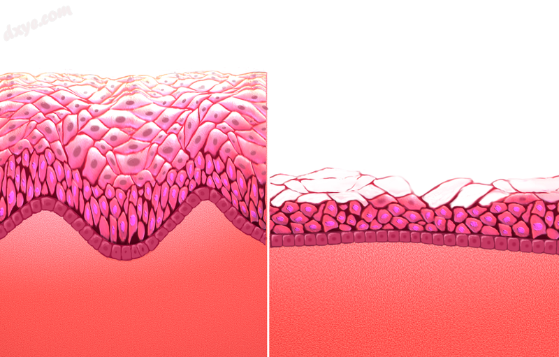 Normal vaginal mucosa (left) versus vaginal atrophy (right).png