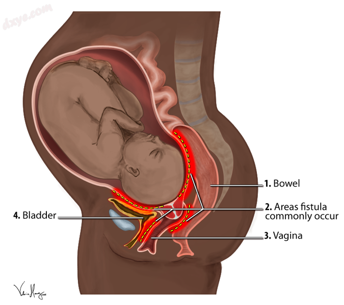 Areas where obstetric fistulae commonly occur.png