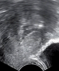 Sonohysterography performed because of postmenopausal bleeding. In serial images.gif