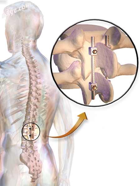 哈氏棒s used in spinal fusion.png