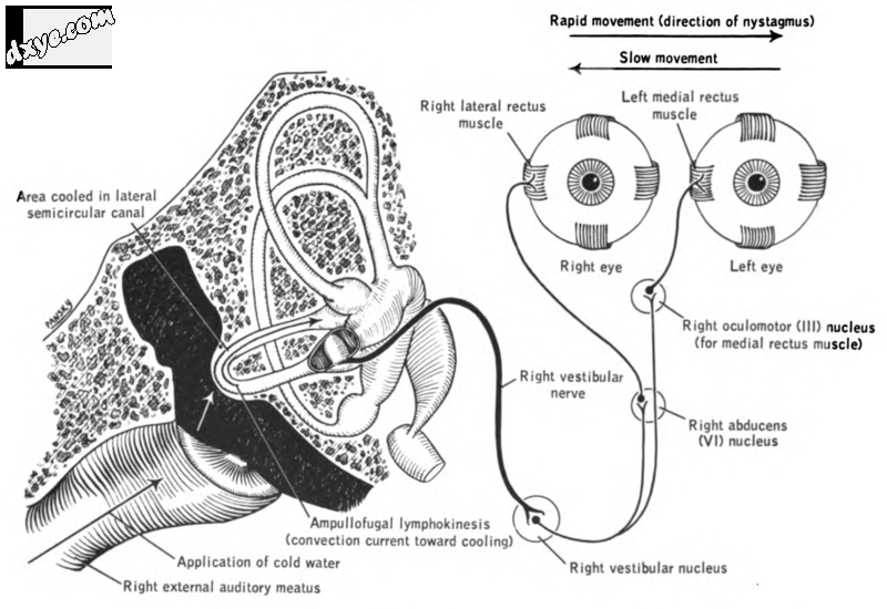 Caloric test. Cold water introduced into right external meatus showing effects o.png