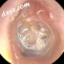 Retracted ear drum.jpg