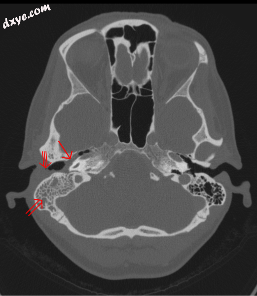 CT scan Otitis media (simple arrow) and mastoiditis (double arrow) of the.png