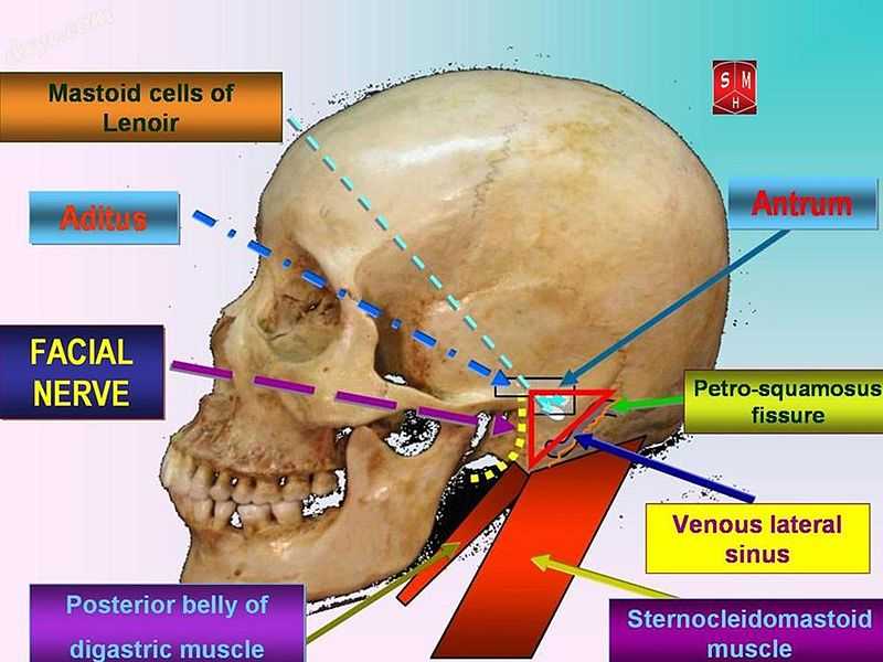 Attack triangle in mastoidectomies.jpg