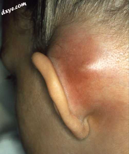 Mastoiditis with subperiostal 脓肿.jpg