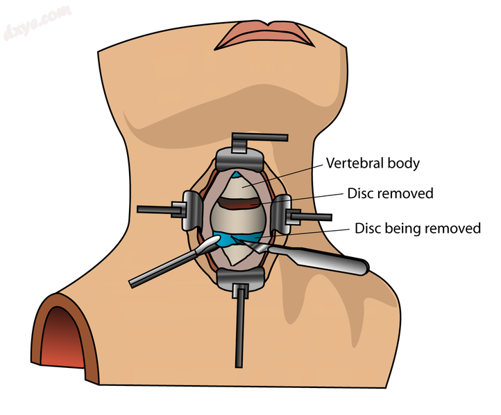 Anterior cervical discectomy.png