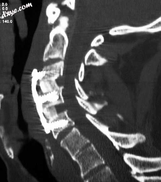 CT scan of a patient after 2-level anterior cervical discectomy.jpg