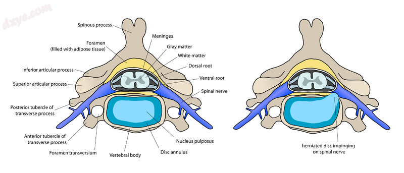 Vertebra and disc normal and herniated situation (top view).png