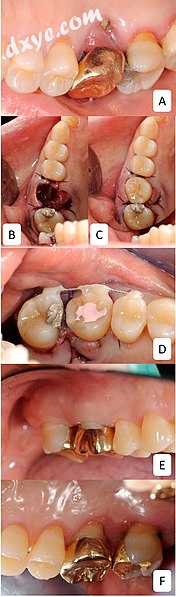 Autotransplantation of wisdom tooth..jpg