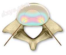 Placement of radio frequency-generated heat probes during a 椎间盘双唇成形术..jpg