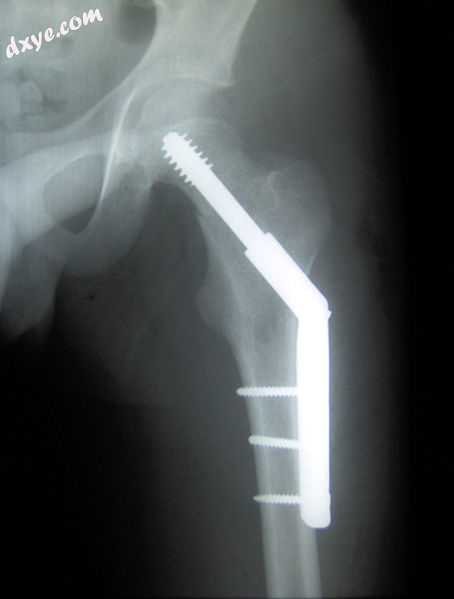 Fracture supported by dynamic hip screw.jpg