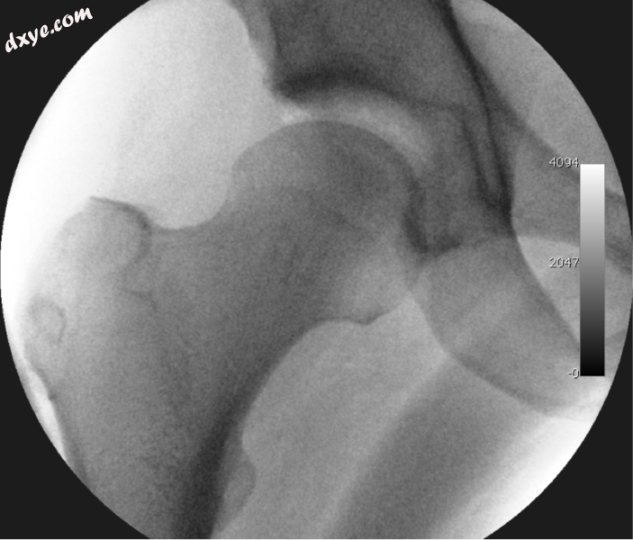 Figure 3. Fluoroscopic picture showing a mild amount of distraction of the hip b.png