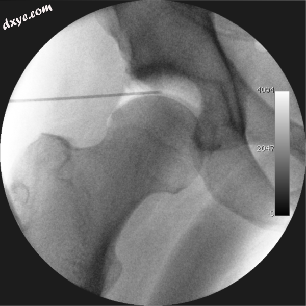 Figure 4. A needle is passed into the joint, breaking the &#039;suction seal&#03.png