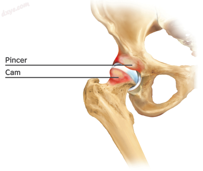 Figure 6. Diagram of the bony pathology of both cam and pincer impingement.png