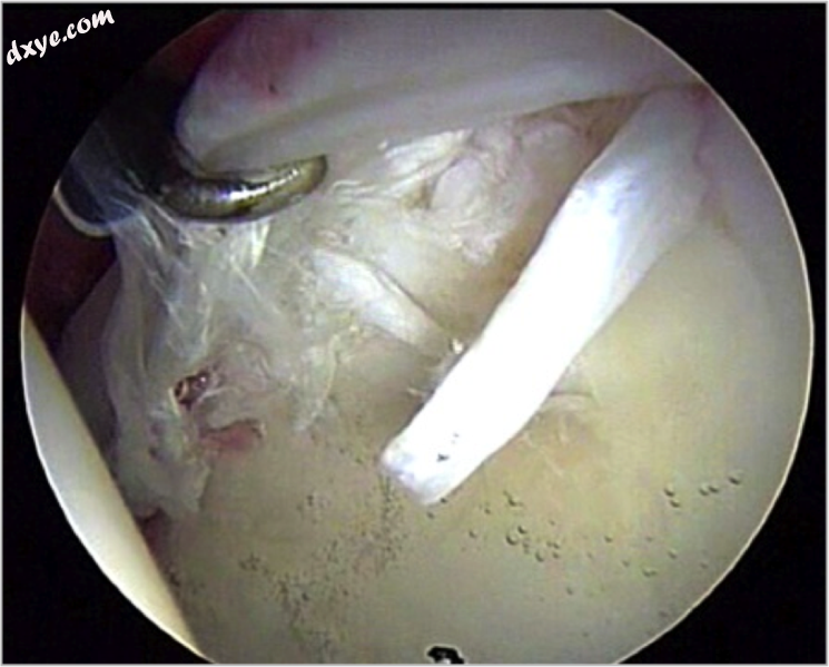 Figure 7. A complex labral tear. An arthroscopic probe is seen at the junction o.png