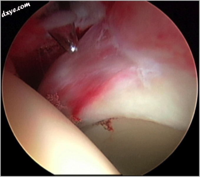 Figure 5. Portal placement under direct vision. The instrument is entering the j.png