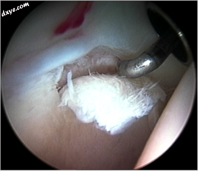 Figure 8.Cartilage delamination. A small area of acetabular cartilage has lifted.png